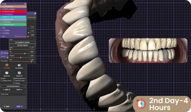 Smile Design Digital Simulation