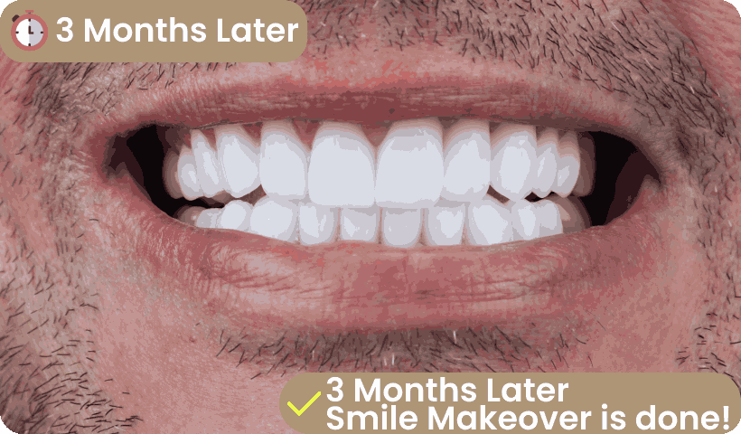 all on four result after 3 months