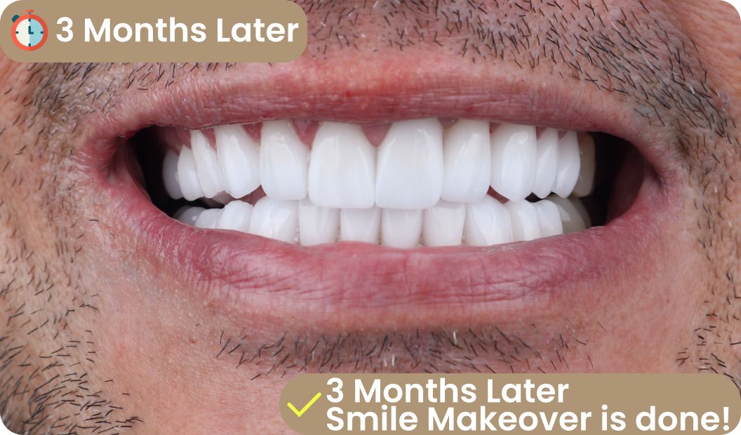 all on four smile result