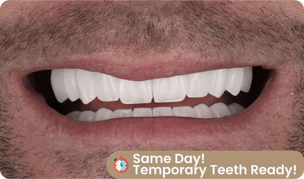 all on four temporary teeth