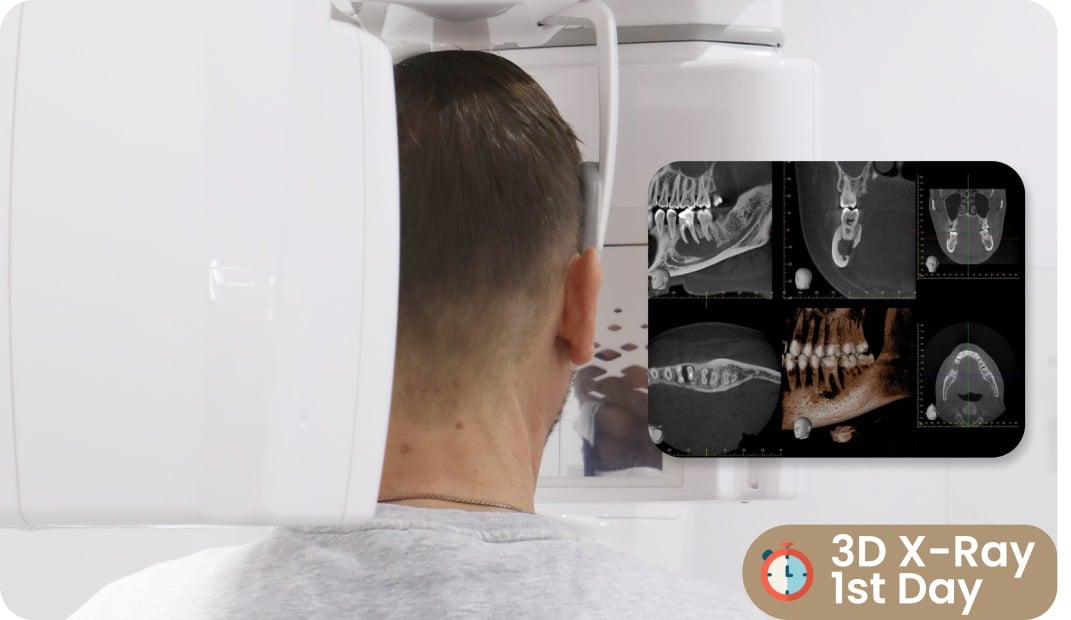 all on four first step implant dentafly