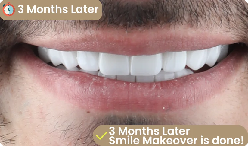 smile makeover all on six process