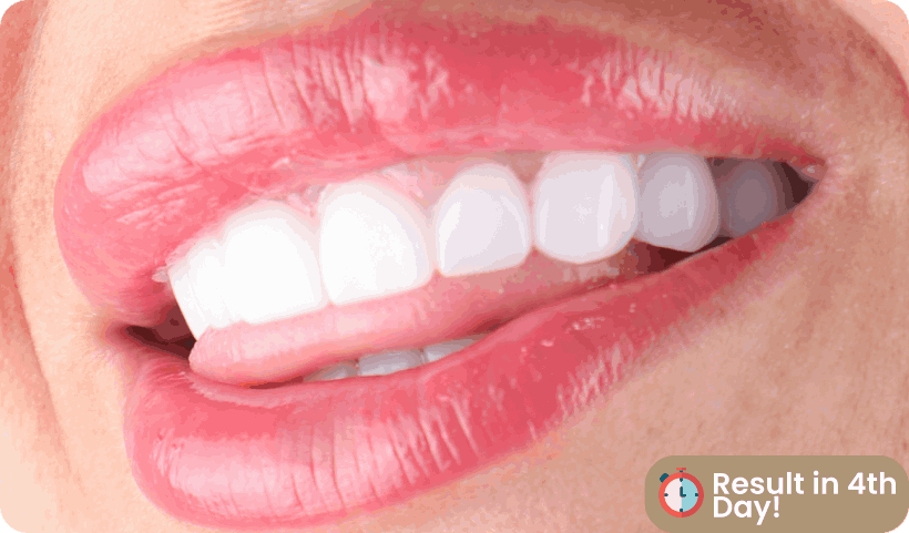 Smile Design 4rd Step Smile Design 4rd Step