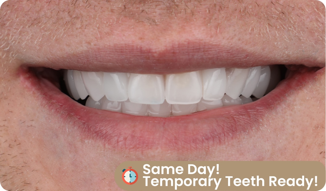 temporary teeth dentafly
