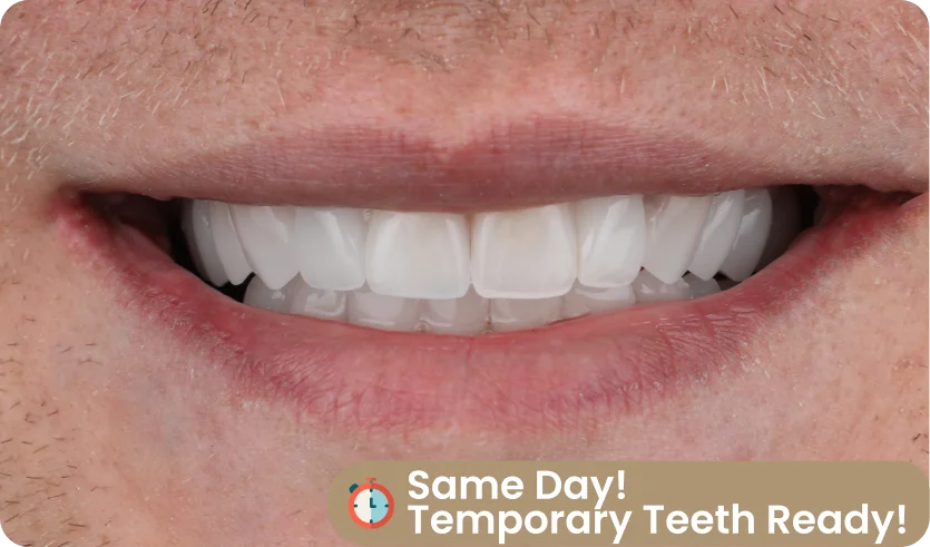 temporary teeth for all on six