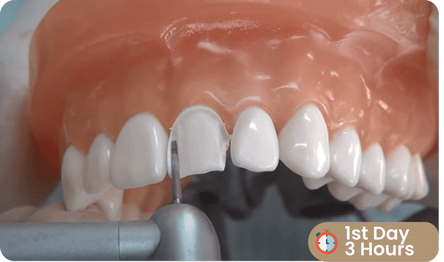 e-max-veneers-antalya