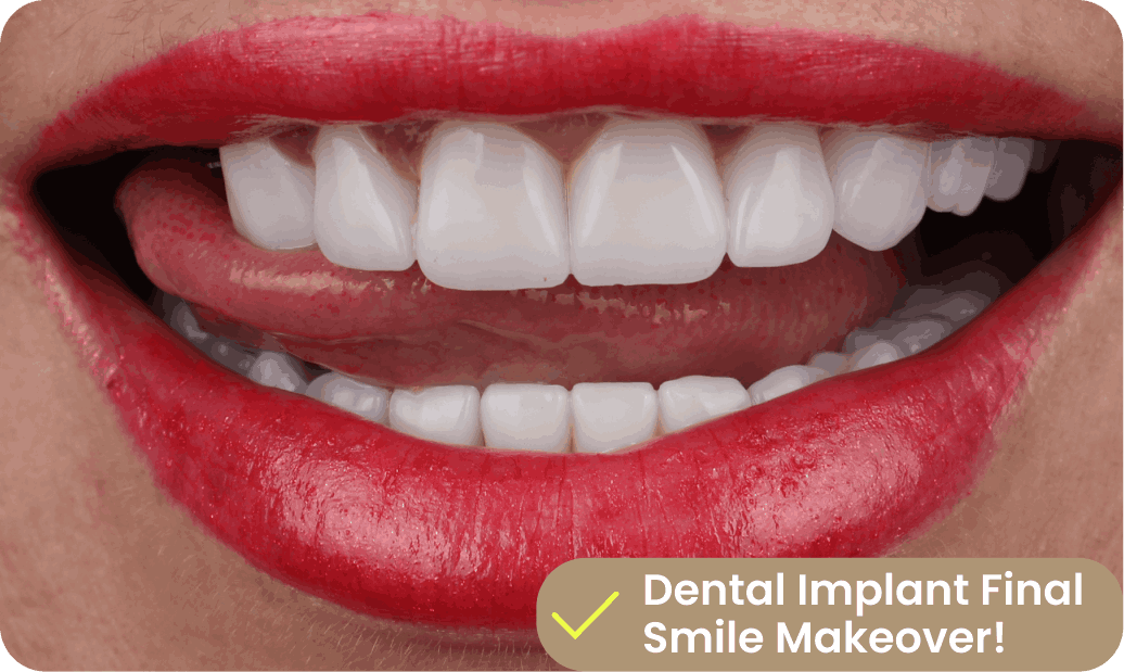 4 after implant treatment