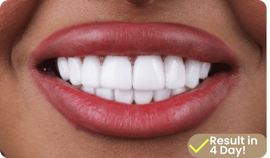 e-max veneers dentafly