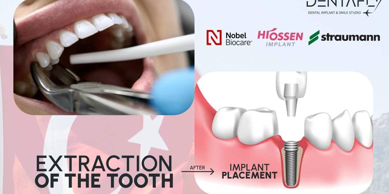 The Process of Wisdom Teeth Extraction: An Overview with Dentists