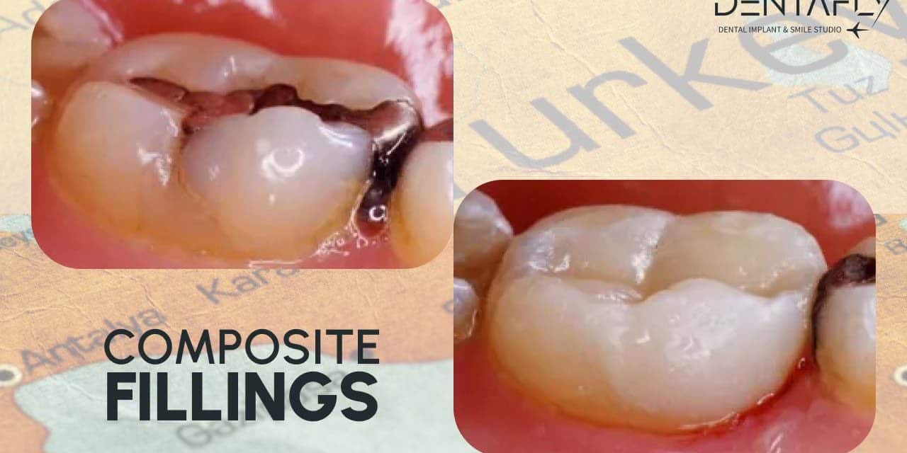 Gum Treatment in Turkey