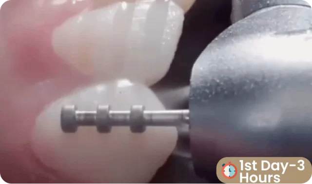 smiledesign-teeth-preparation-3rd-antalya smile design teeth preparation process