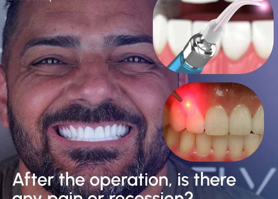 Hyperpigmentation: Removal of Pigmentations, Gingiva