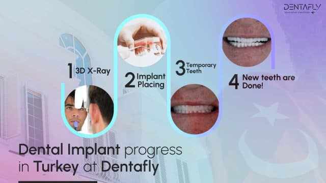 dental implant process view in Turkey dentafly