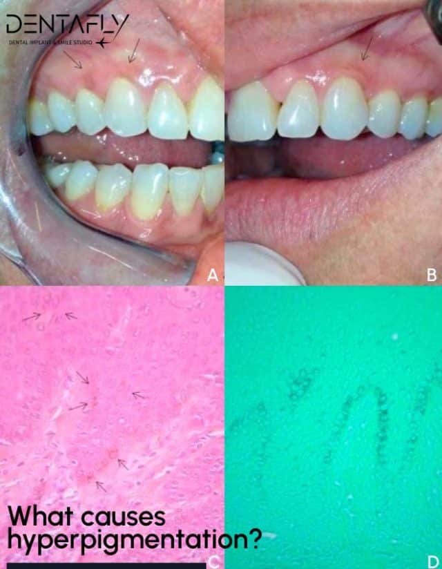 Hyperpigmentation before and after