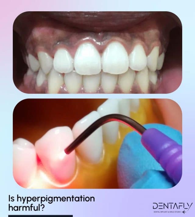 Side effects of Hyperpigmentation