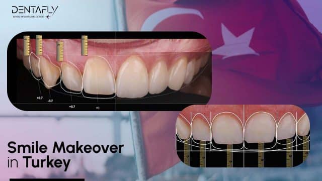 Smile Makeover in Turkey