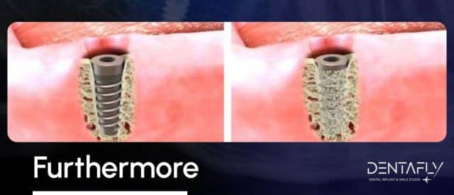 after osseointegration treatment