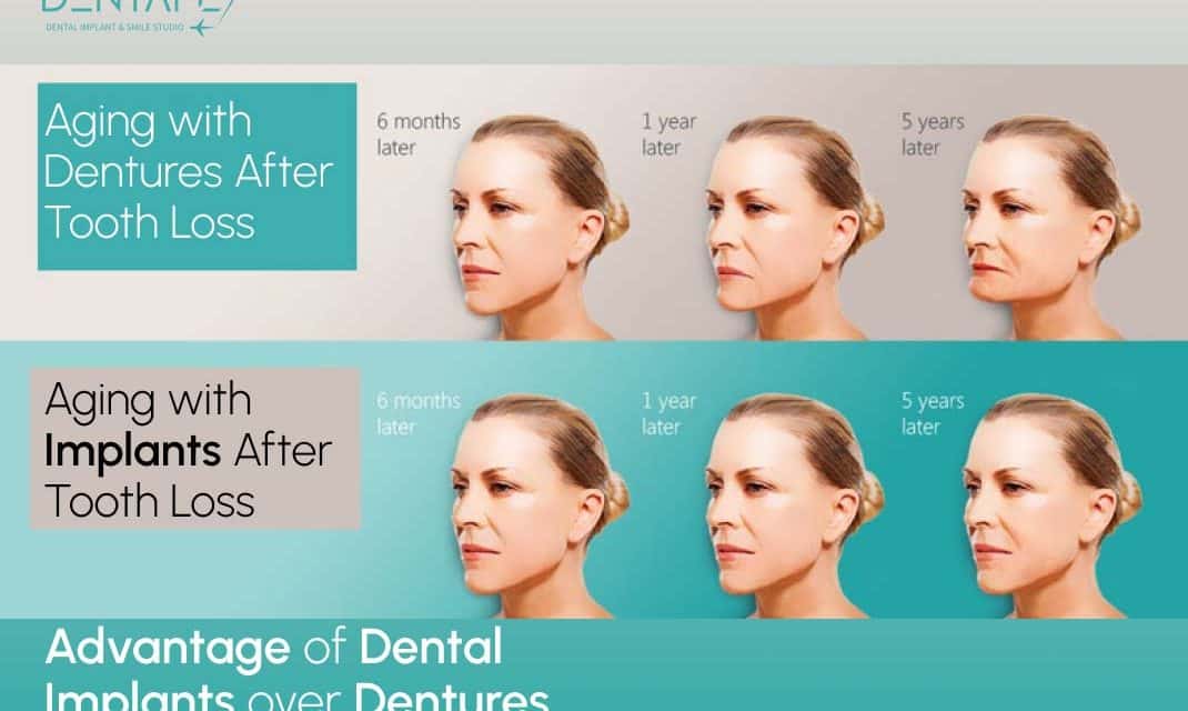 Importance of Dental Implants – 6 Hidden Truths