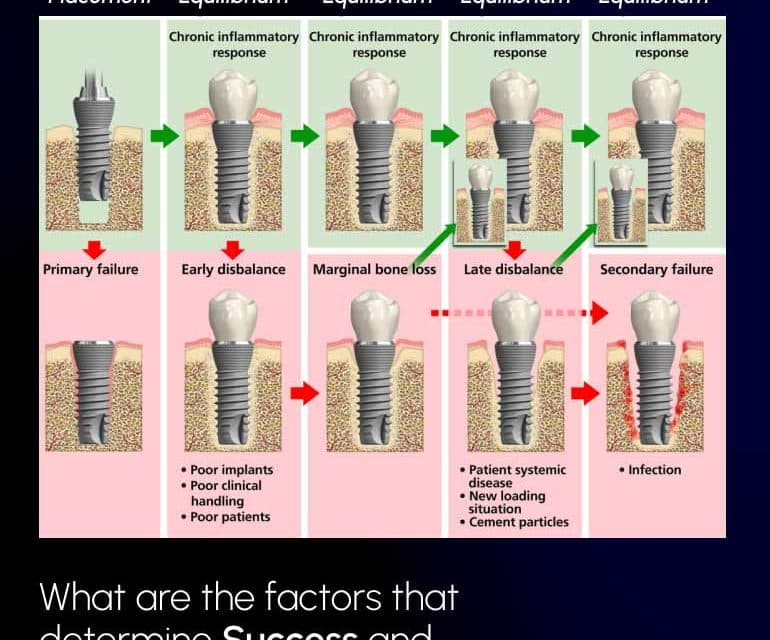 Osseointegration: A to Z Overview