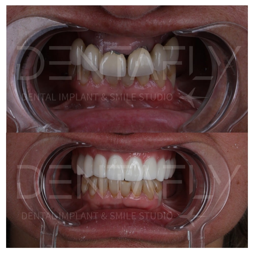 A very hard and broken teeth in the top that fixed with the all on four methods
