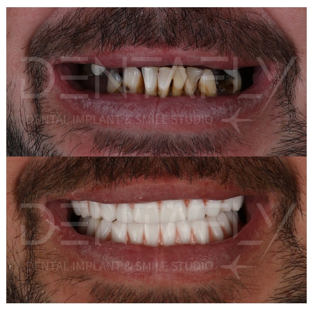 All on Four Before After cases done in Mersin Turkey