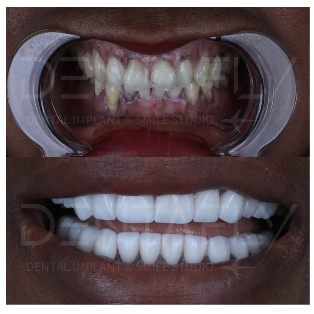 All on Four Before After cases done in Bursa Turkey