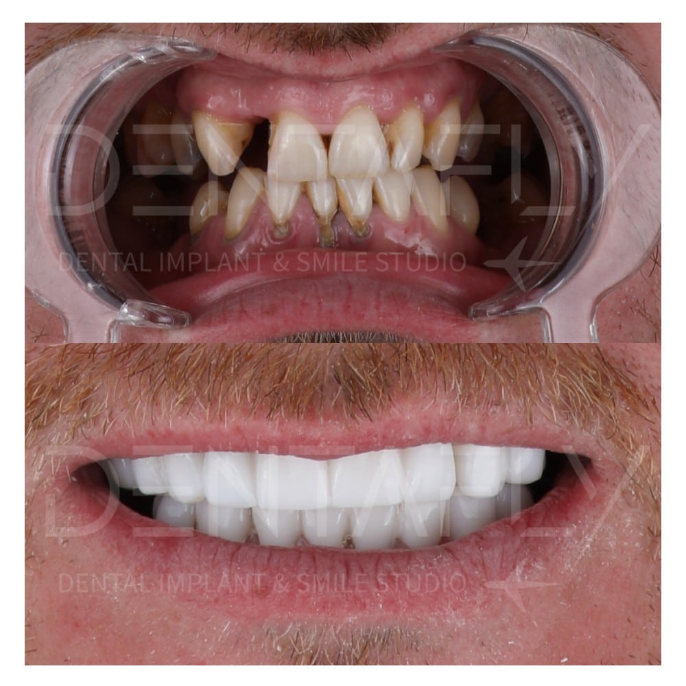 all on four before after photo in Turkey