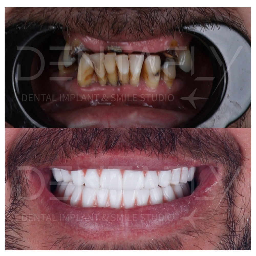 before-after-all-on-six-1