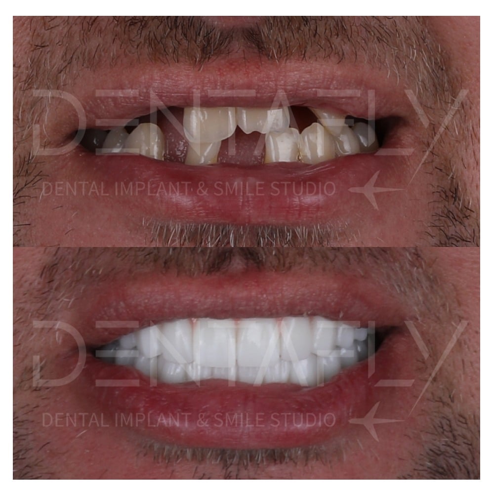 before-after-all-on-six-10