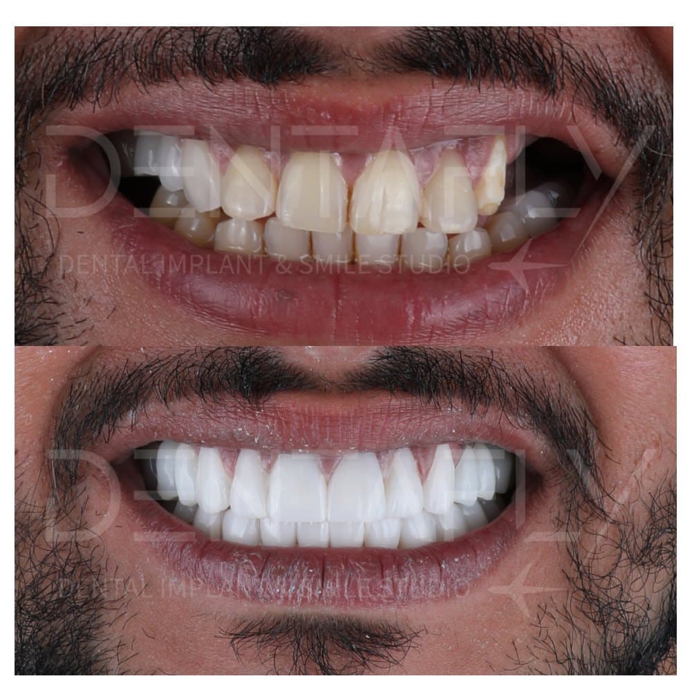 before-after-all-on-six-14