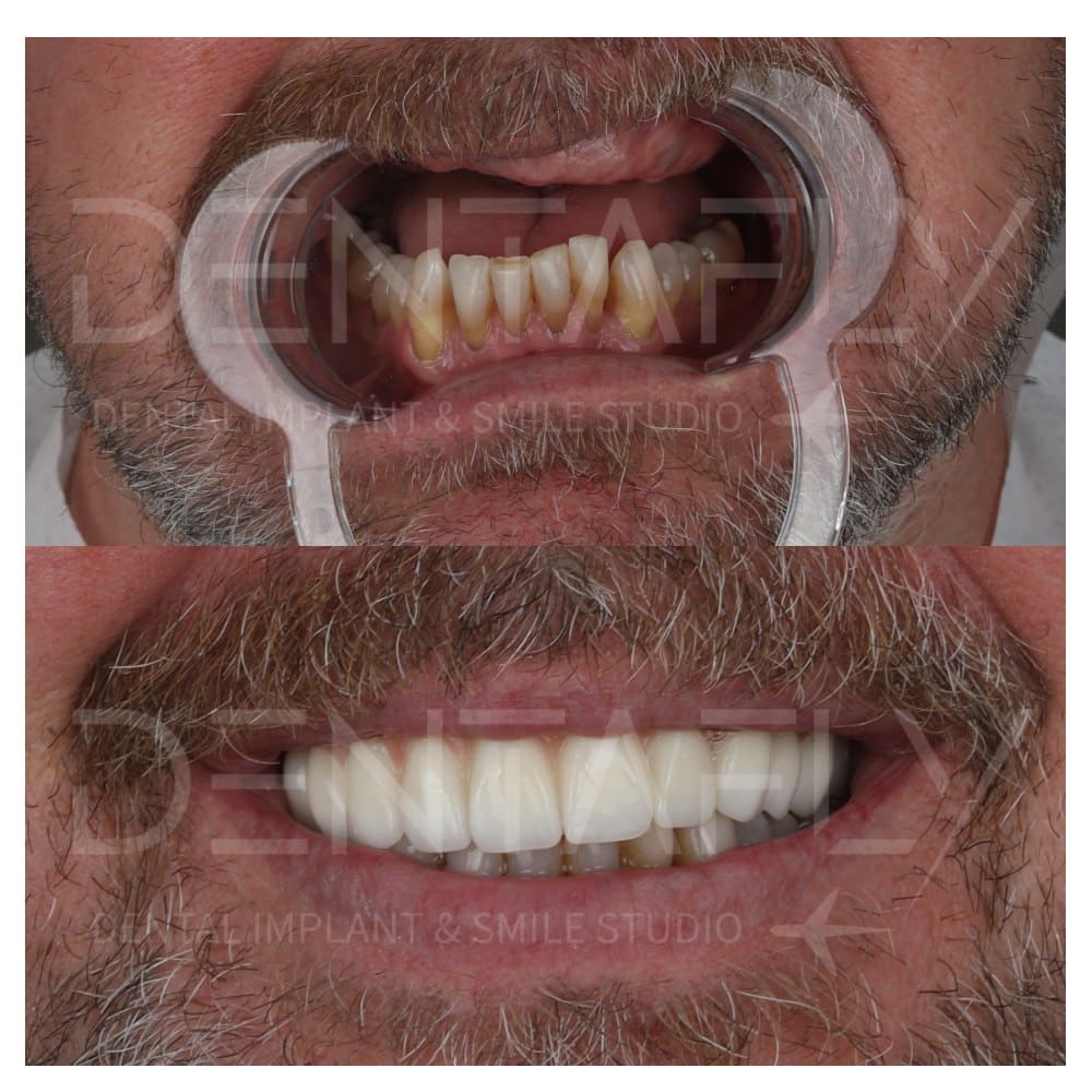 before-after-all-on-six-16