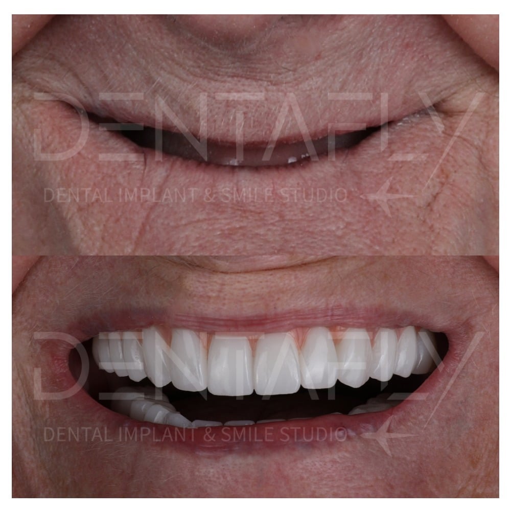 before-after-all-on-six-2