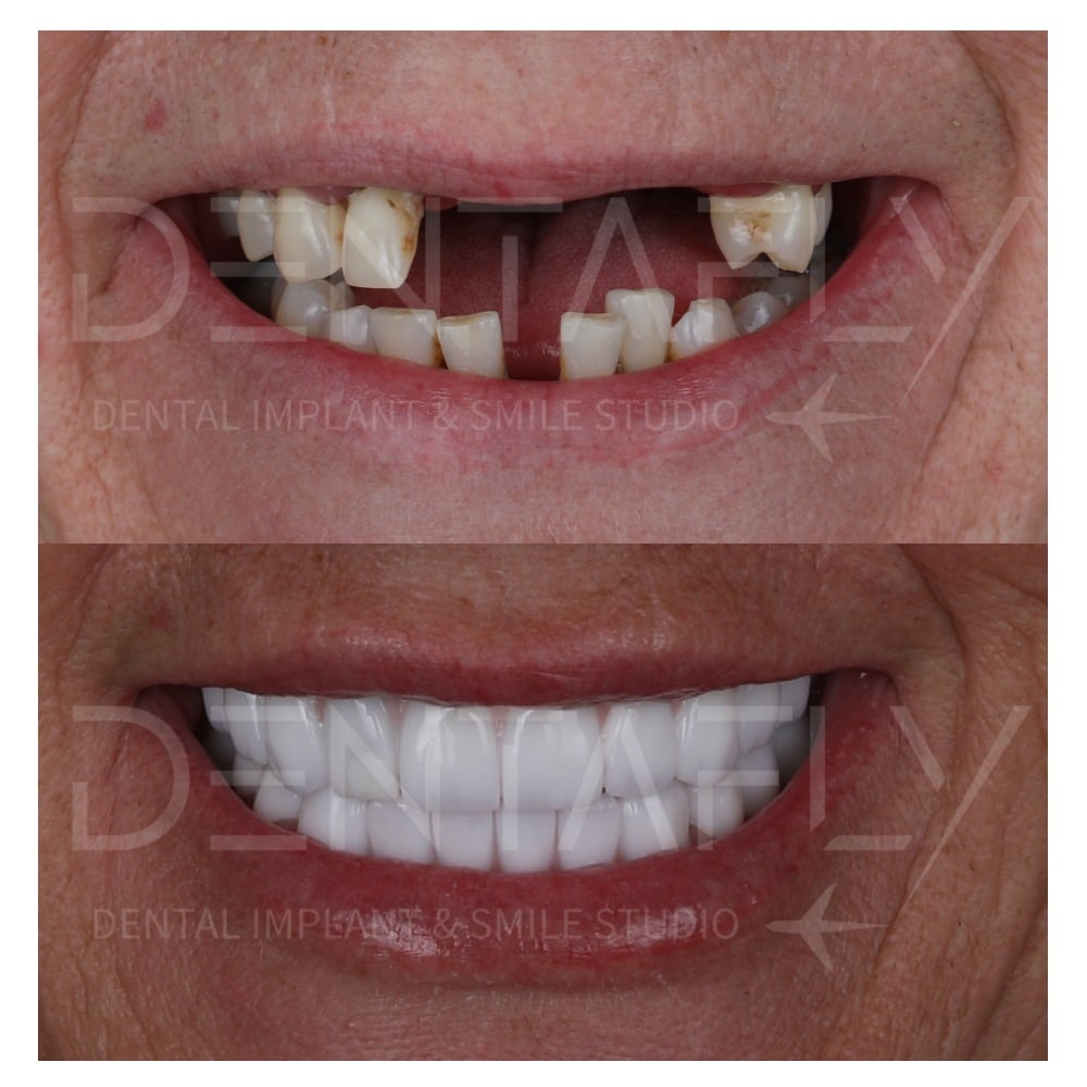 before-after-all-on-six-3