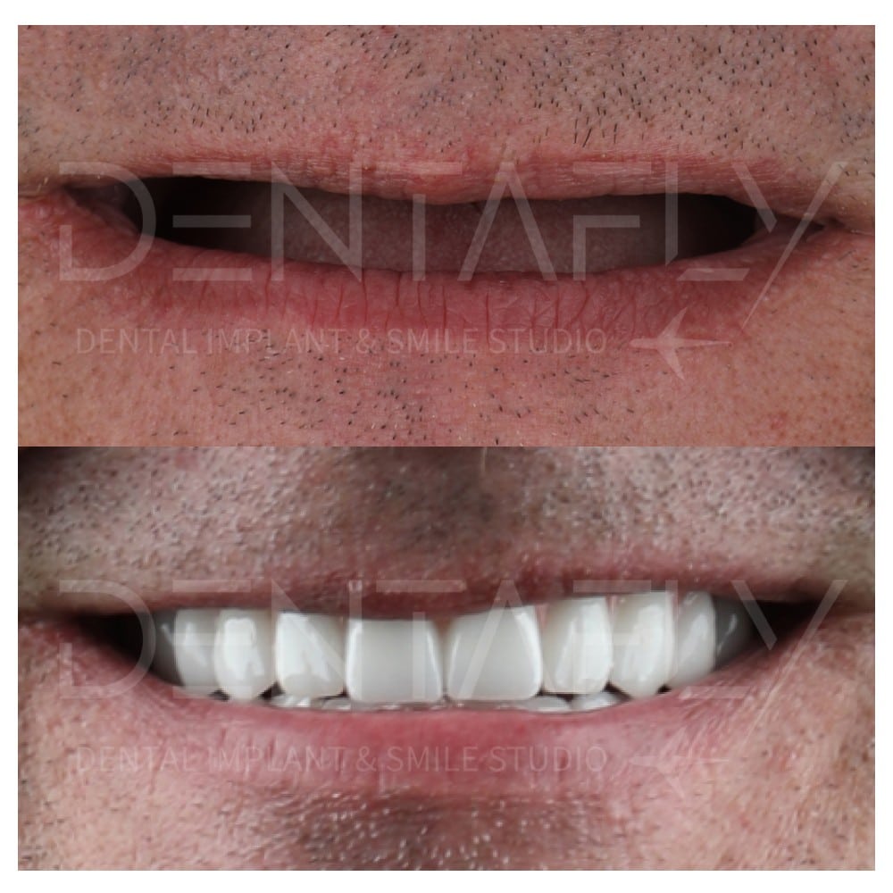 before-after-all-on-six-4