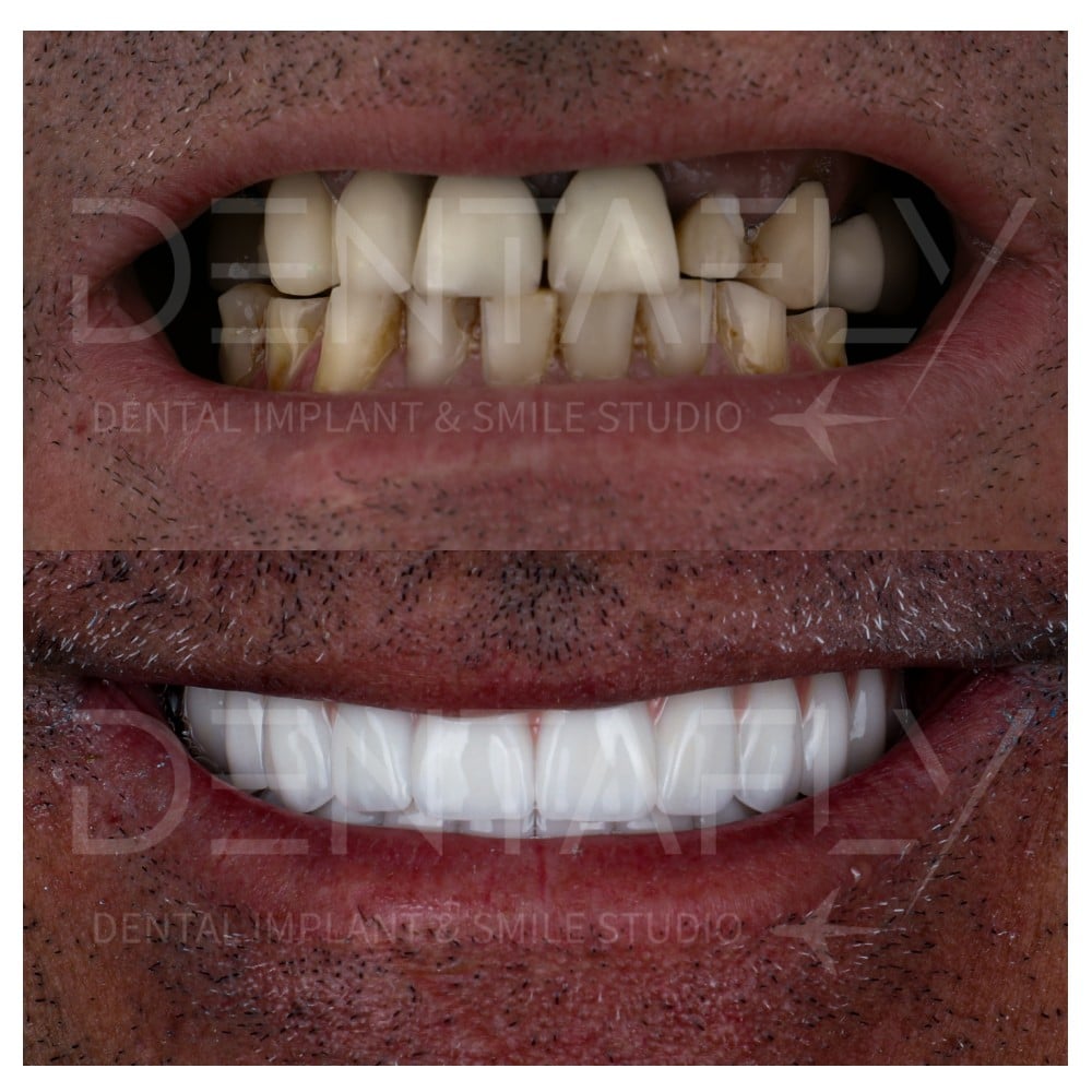 before-after-all-on-six-5