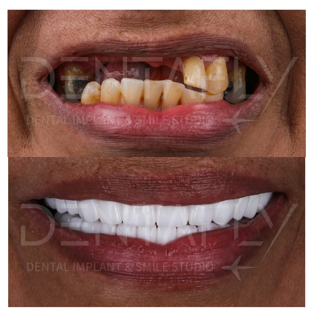 before-after-all-on-six-7