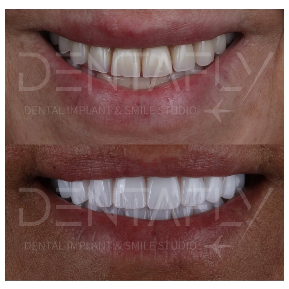 before-after-all-on-six-9