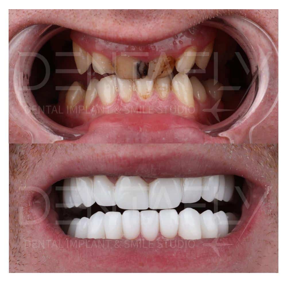 Before After views of Dental Implant Treatment