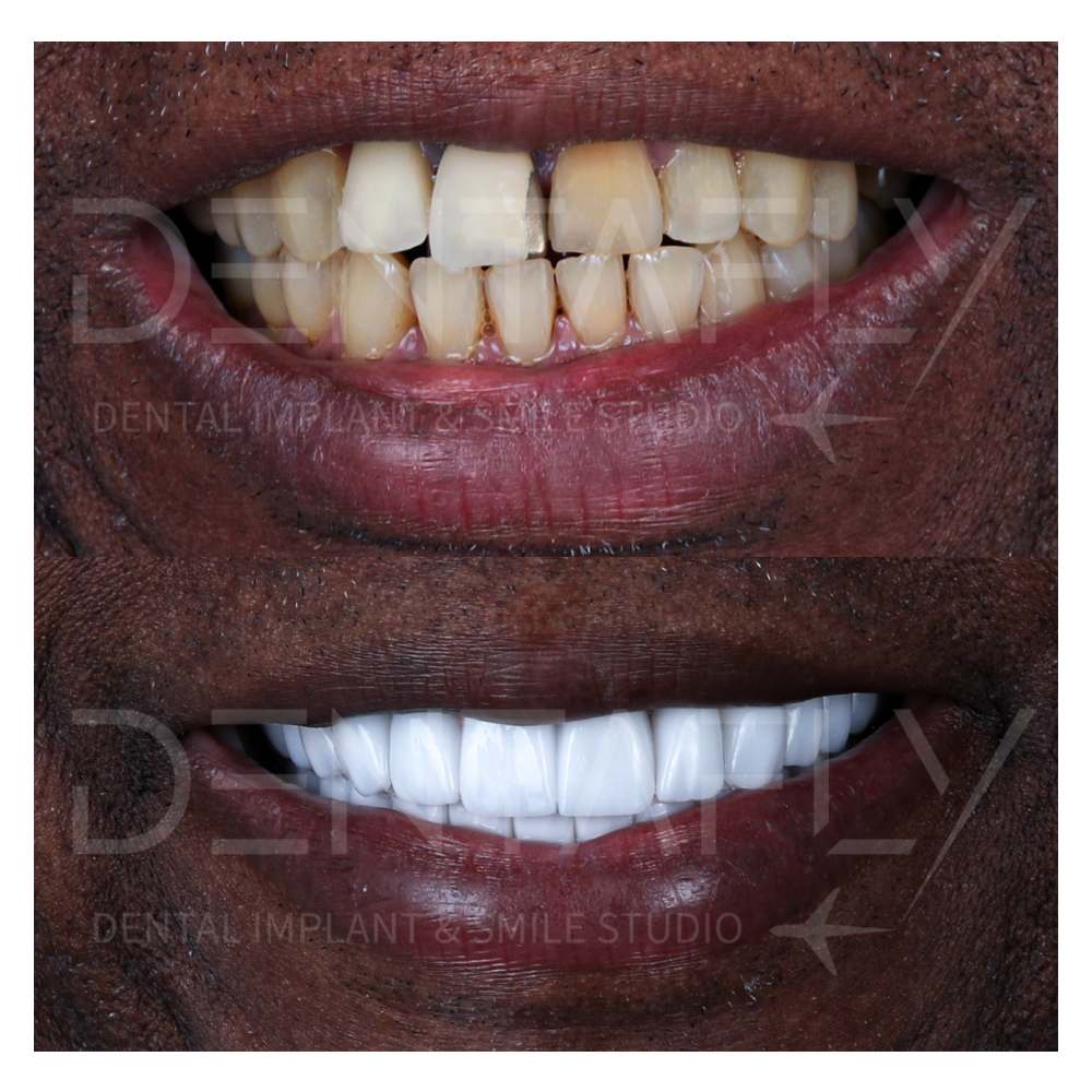 Dental Implant Before After Photos