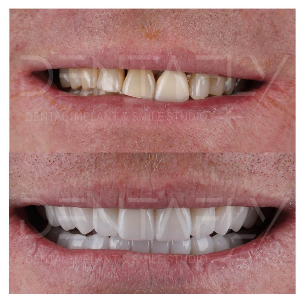 Dental Implant Photos done in Turkey