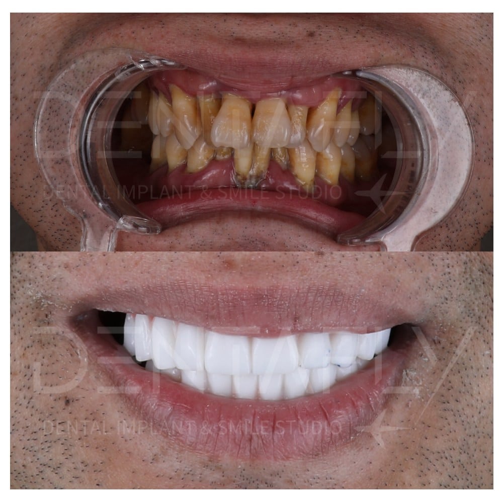 smile-design-before-after-21