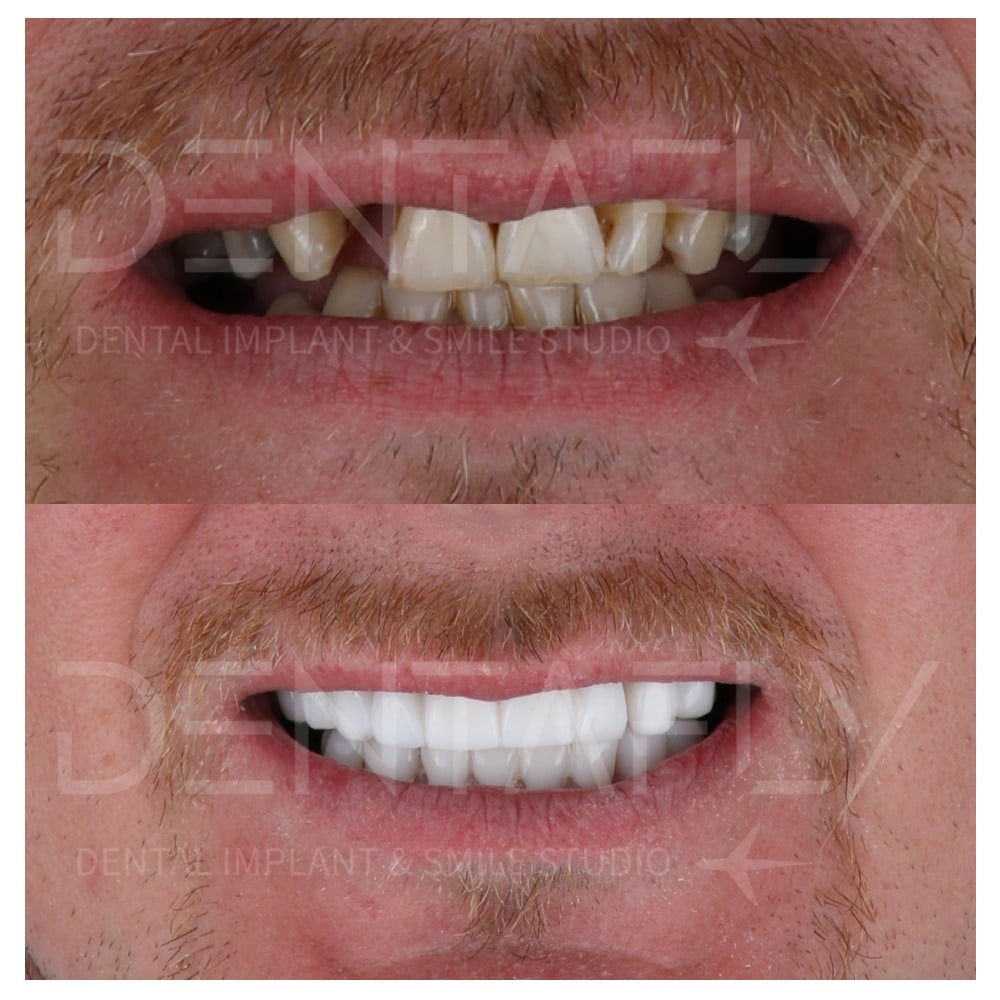 smile-design-before-after-4