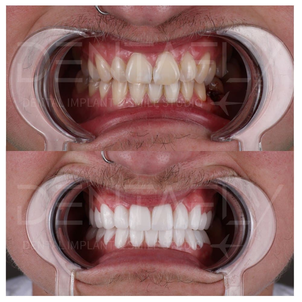 smile-design-before-after-6