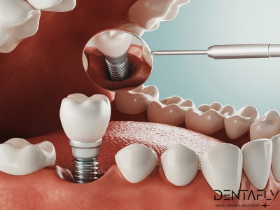 Bleeding after dental implant
