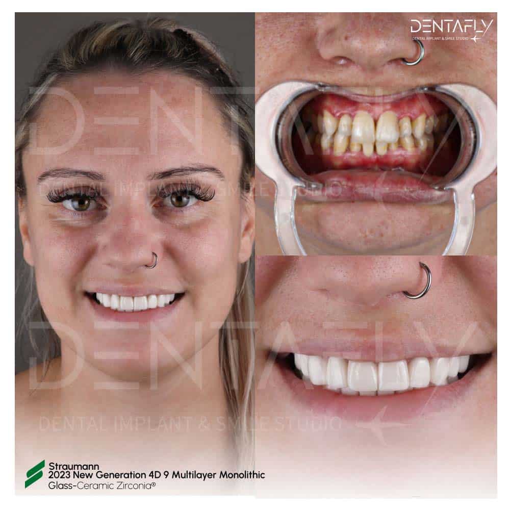 Before After Straumann Teeth