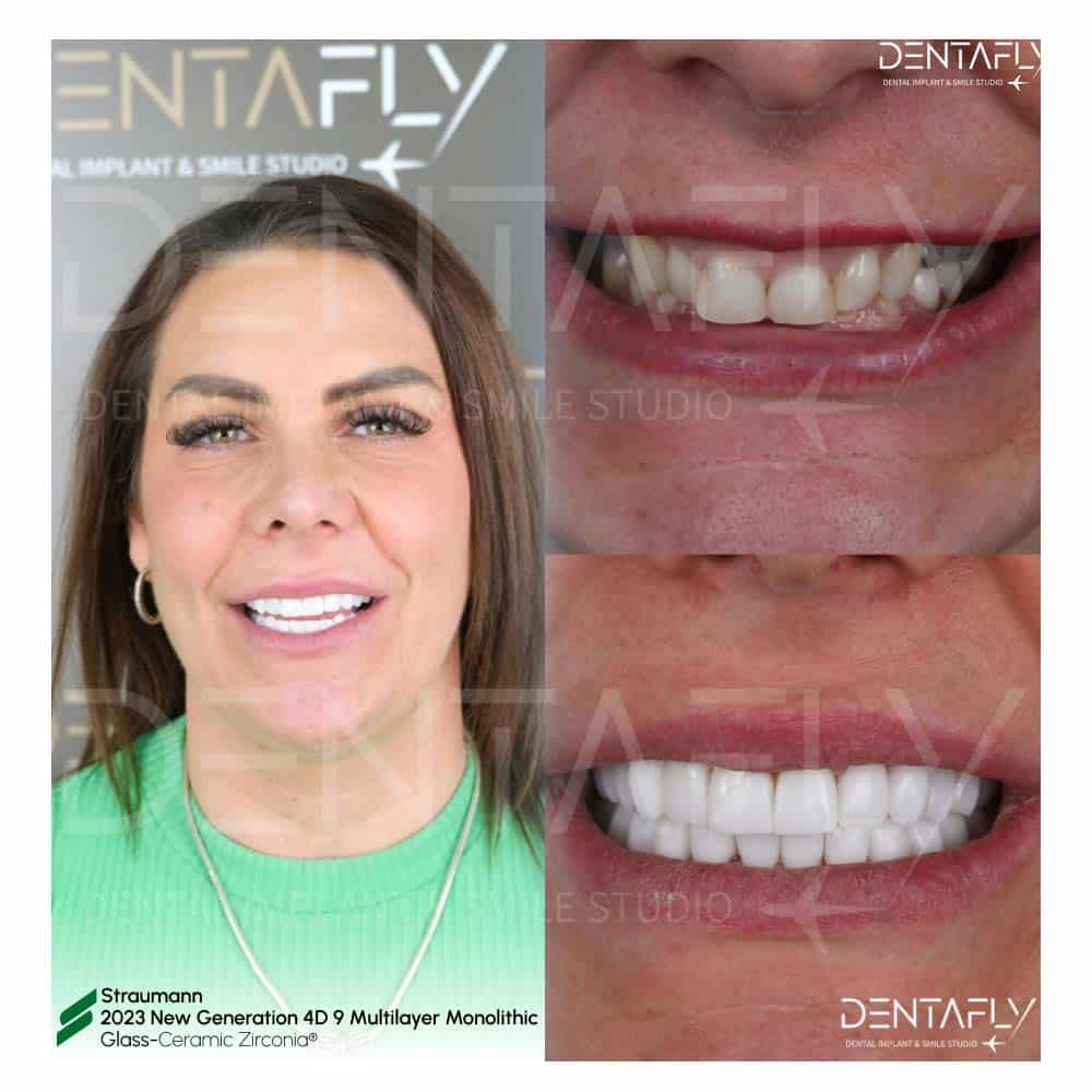 Before After 4D Multilayer Crowns Before After 4D Multilayer Crowns