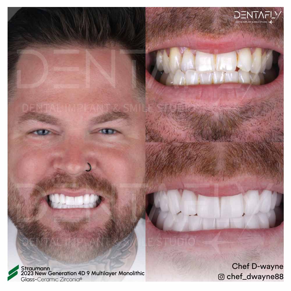Chef D Wayne Before After Teeth
