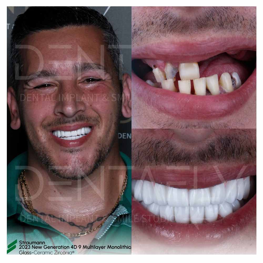 Before After All on 4