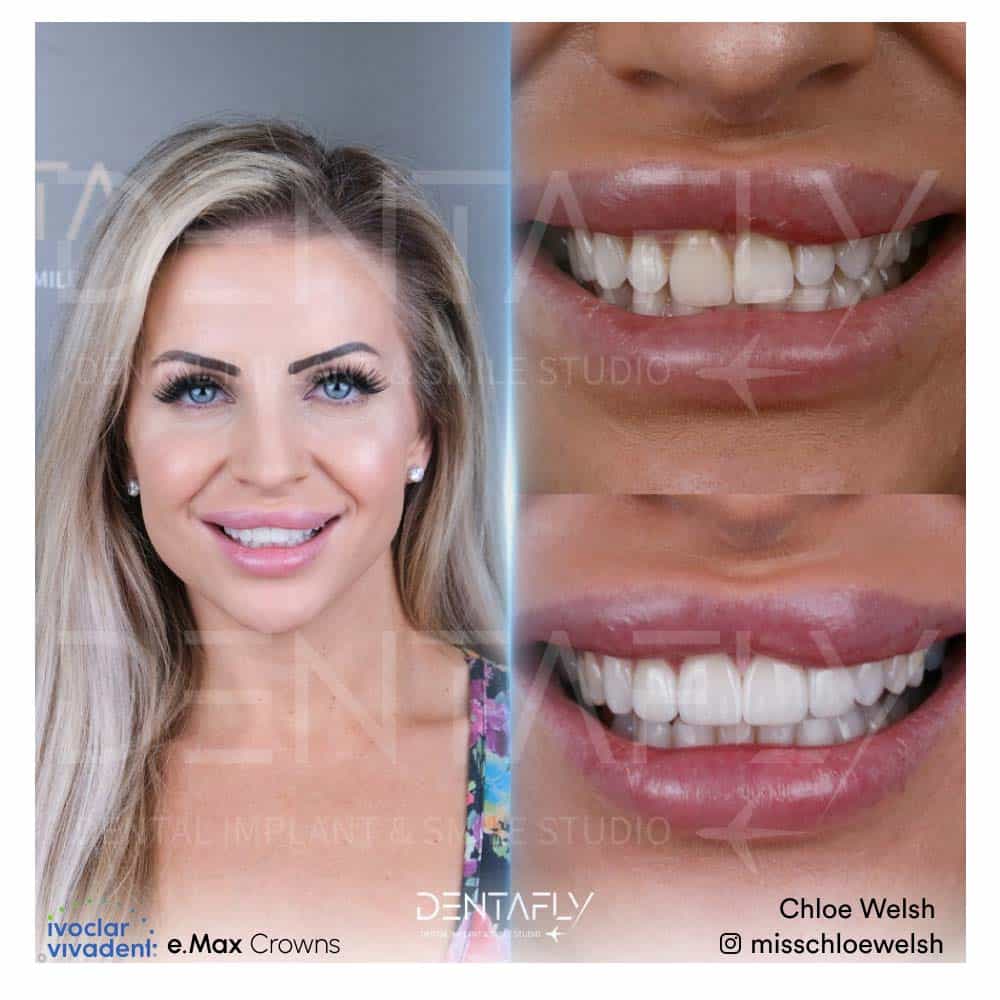 Chloe Welsh - Before and After Chloe Welsh - Before and After