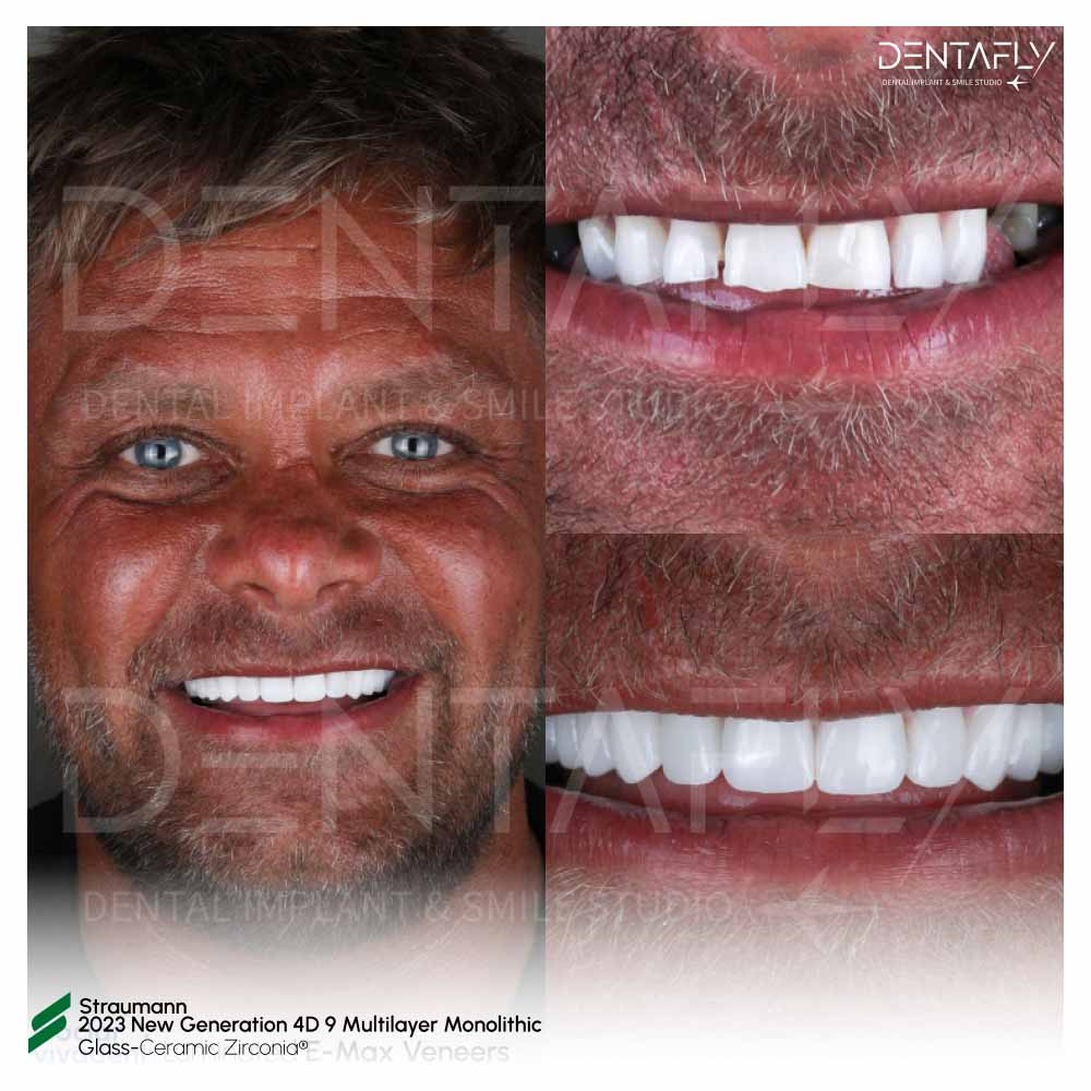 Straumann Zirconia Crowns Before After